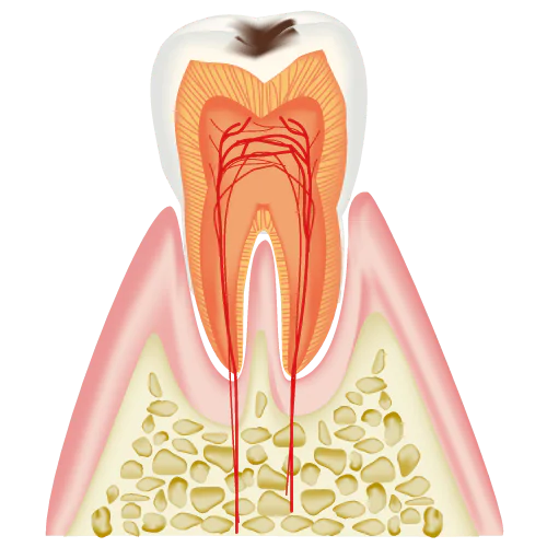 初期むし歯(C1)