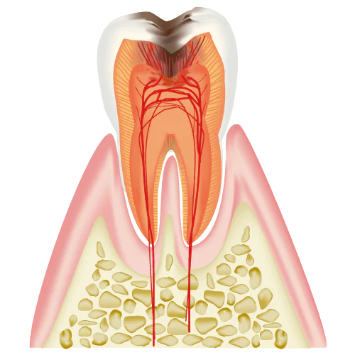 神経に達したむし歯(C3)