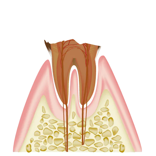 歯根だけ残ったむし歯(C4)