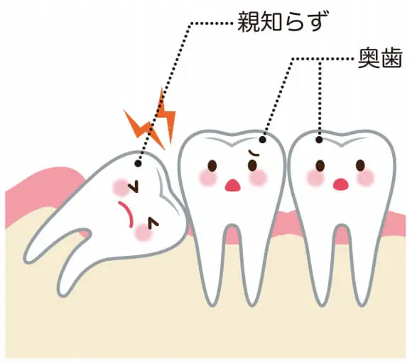 親知らずの抜歯