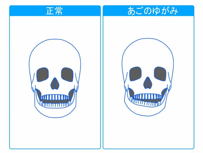 顎関節症の治療