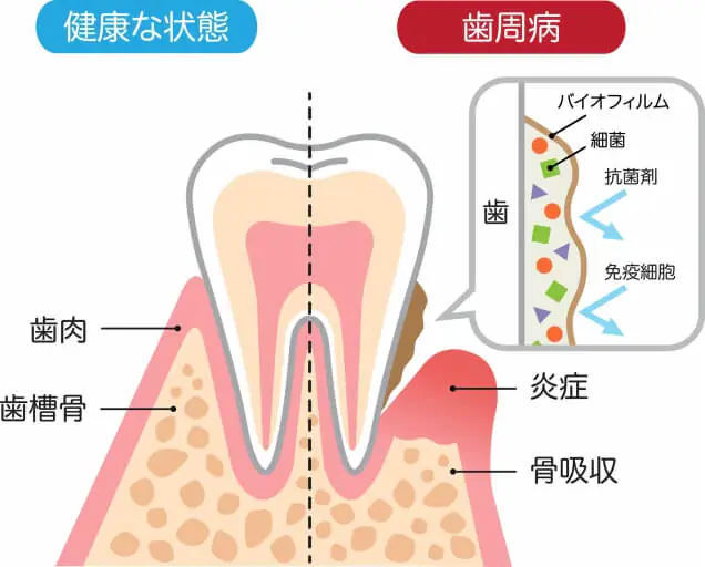基本的な歯周病治療について